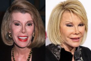 Joan Rivers Plastic Surgery Before & After