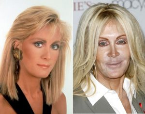 Joan Van Ark Plastic Surgery Before & After