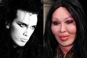 Pete Burns Plastic Surgery Before & After