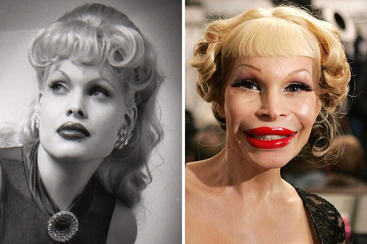 Top 20 Celebrity Plastic Surgery Gone Wrong Photos (Before & After