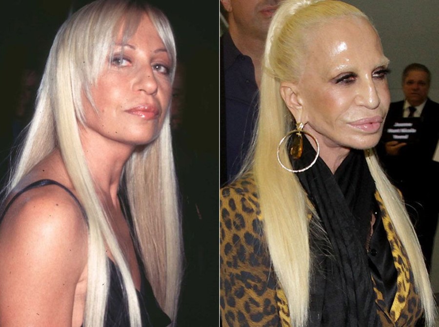 Donatella Versace Plastic Surgery Before & After