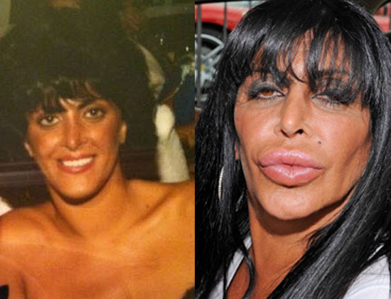 big-ang-plastic-surgery-before-and-after.